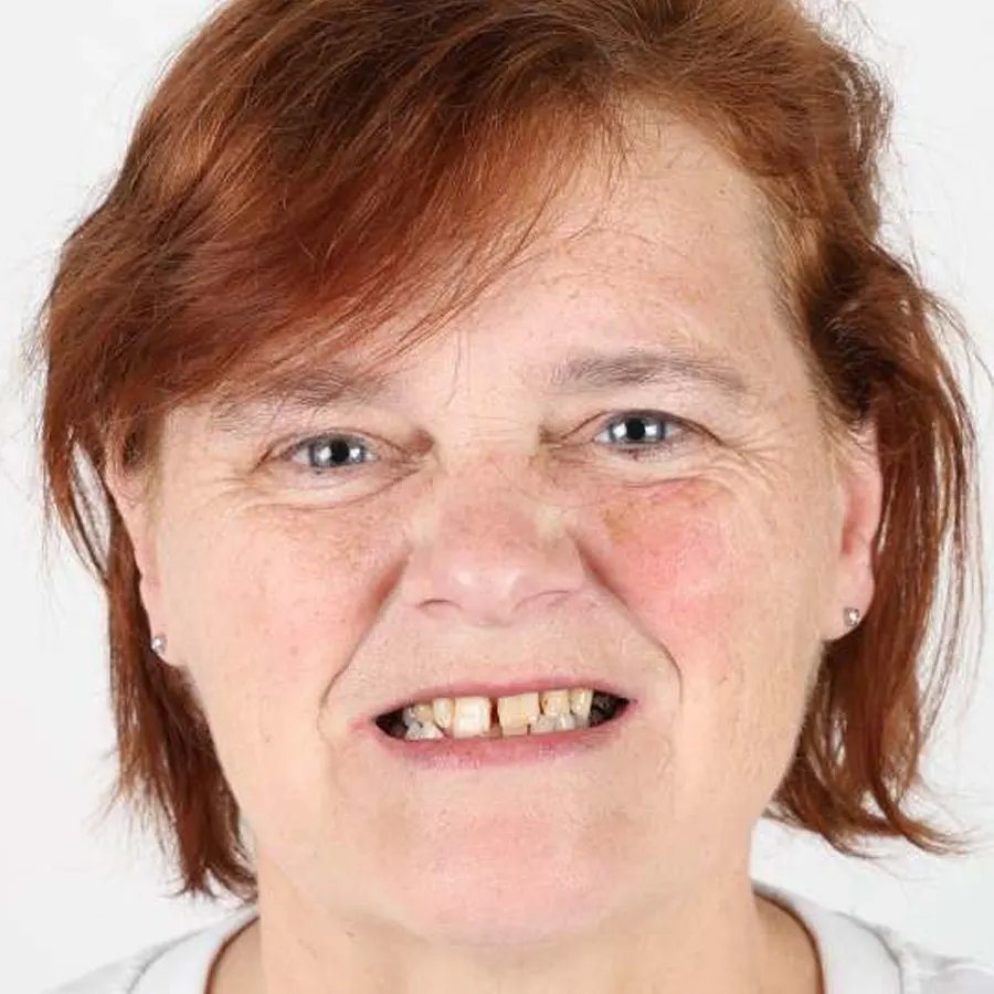 Smile makeover — Before