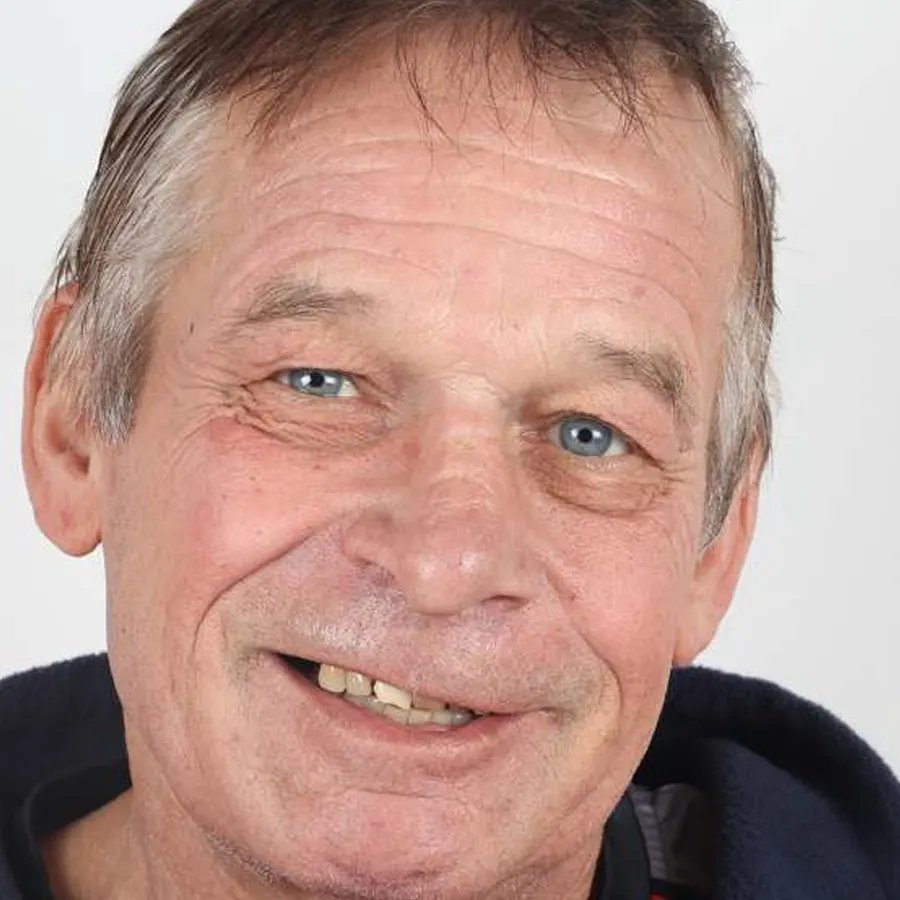 Smile makeover — Before