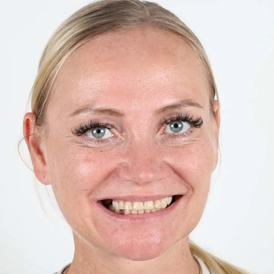 Smile makeover — Before