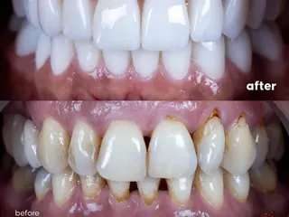 All-on-4 + Zirconium Crown on Implant — detail