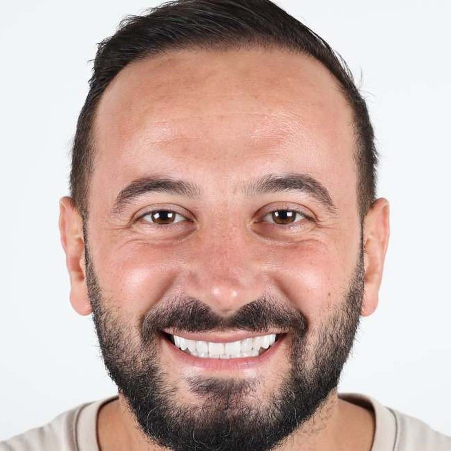 Smile makeover — After