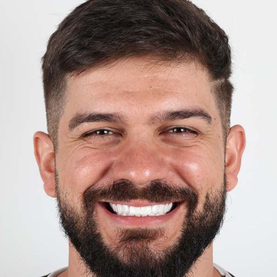 Smile makeover — After