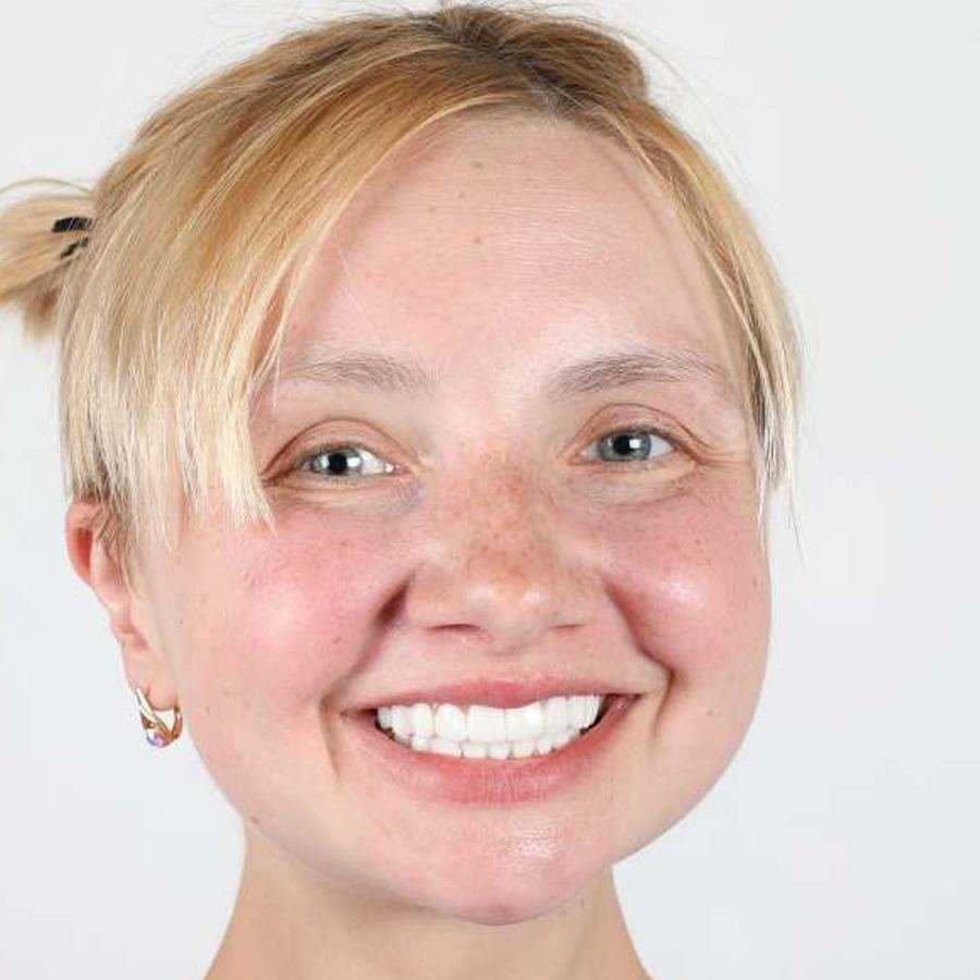 Smile makeover — After